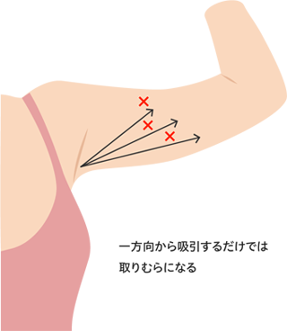 一方向からの吸引
