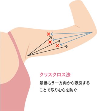 クリスクロス法による吸引