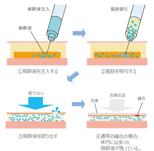通常の脂肪吸引手術図解