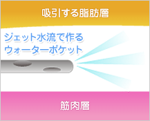 ウォータージェット脂肪吸引術図解