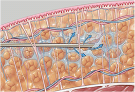 1. 麻酔液を皮下脂肪層に満たします