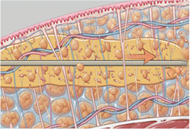 2. ベイザー波で脂肪のみを乳化させます