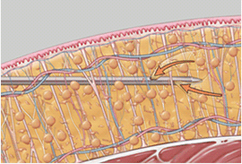 3. 刃の内ないカニューレで 脂肪だけ根こそぎ吸引します