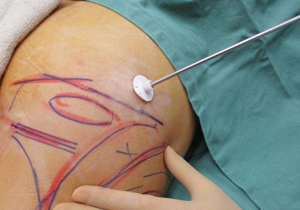 スキンプロテクター