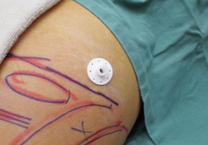 スキンプロテクター