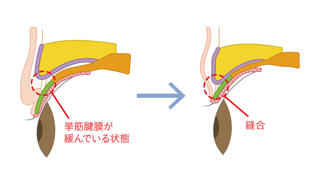 瞼板と眼瞼挙筋の間は、健膜腱膜という構造になっており、加齢などで健膜が伸びる（ゆるくなる）と、筋肉の力が瞼板に伝わりにくくなり、まぶたが開きにくくなります。
