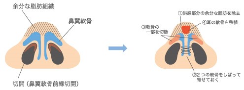 団子鼻を小さくするために