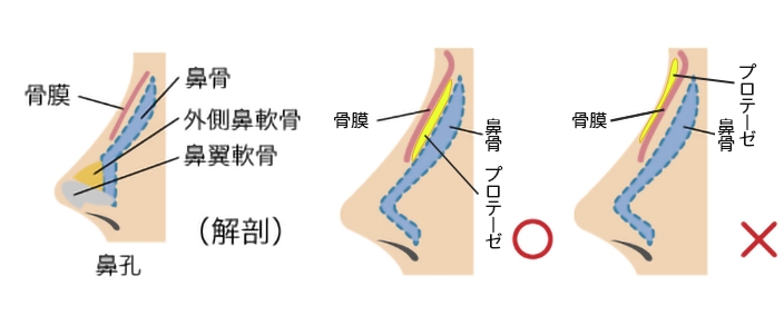 プロテーゼは骨膜下に挿入する
